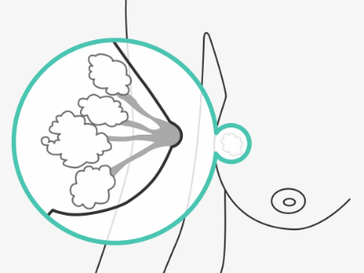 A breast surgery demonstration