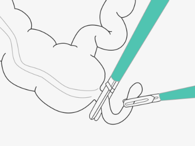 Miniially invasive surgery being performed