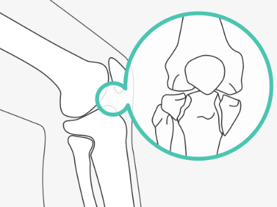 A an image of damaged joint