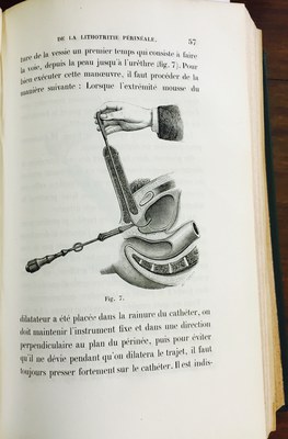 H.F.Dolbeau - De la lithotritie périnéale, ou, Nouvelle manière d'opérer les calculeux