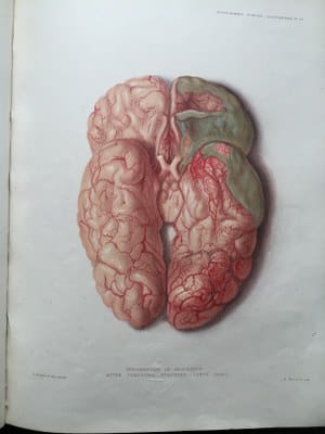 Sir Jonathan Hutchinson - Illustrations of Clinical Surgery (4)