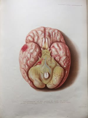 Sir Jonathan Hutchinson - Illustrations of Clinical Surgery (5)