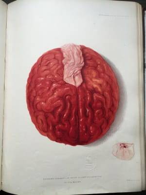Sir Jonathan Hutchinson - Illustrations of Clinical Surgery (6)
